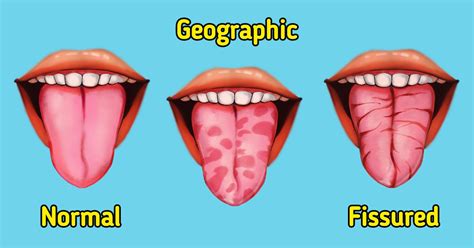 What A Geographic And Fissured Tongue Is 5 Minute Crafts