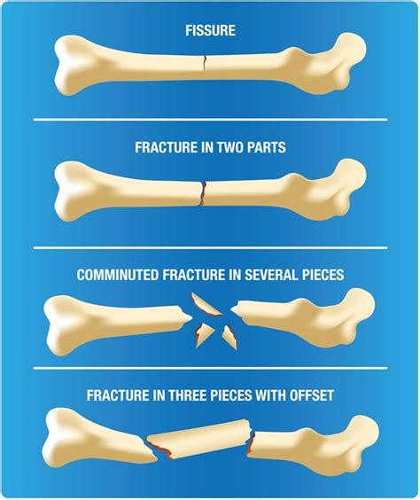 Bone Fractures Types Symptoms Treatment OFF