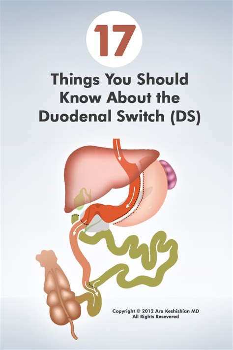 17 Things You Should Know About The Duodenal Switch Ds Artofit