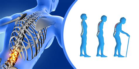 What Is Osteoporosis Symptoms Causes And More Osteoporosis Causes
