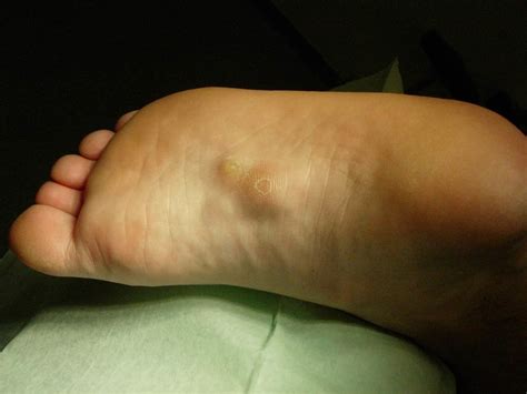 The plantar warts are healed without any treatment. What Is Plantar Fibroma? (Symptoms, Treatment and Recovery)