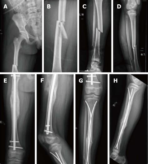 Figure 1 From Ipsilateral Femur And Tibia Fractures In Pediatric