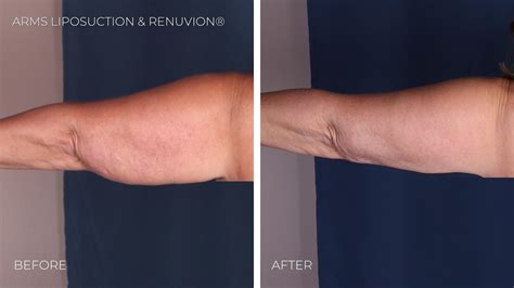 Arms Liposuction Omaha Liposuction By Imagen
