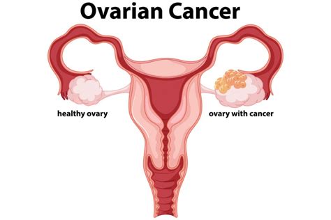 Ovarian Cancer Stages Causes Symptoms And Treatment Parkway East