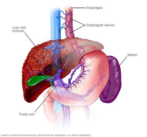 Arteries and veins can carry either deoxygenated or oxygenated blood. Esophageal varices Disease Reference Guide - Drugs.com