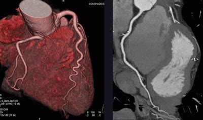 Ct scanning of the heart can help diagnose and monitor coronary artery disease (cad) or aid in valve replacement surgery. Severe coronary disease diagnosed by CTCA :: The surrey ...
