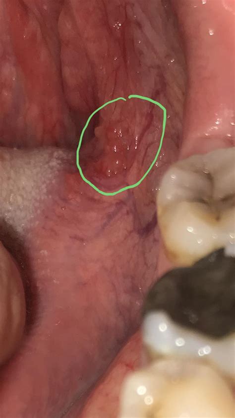 Anybody Know What These Bumps Can Be Near The Back Of My Tongue They