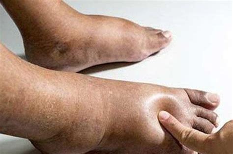 Causes Of Swollen Feet In Diabetics And How To Overcome It All Pages