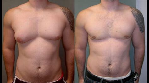 man boobs called gynecomastia how to get rid of it