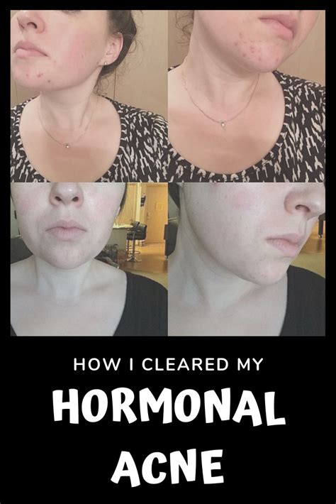 How To Clear Up Hormonal Chin Acne Shearlingwomenbestquality
