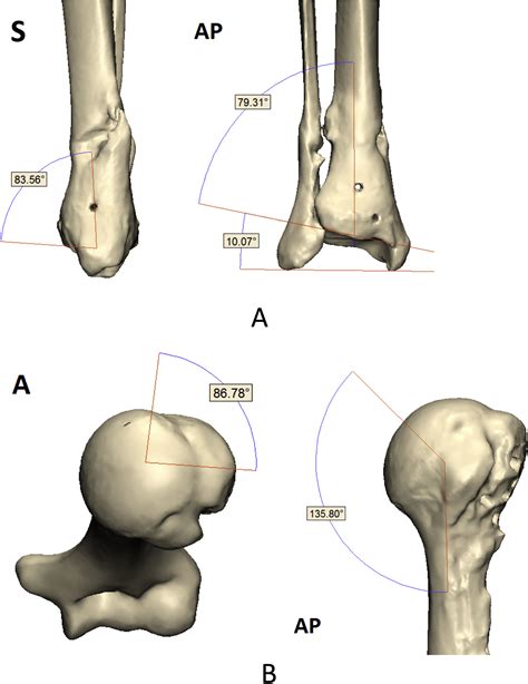 Corrective Limb Osteotomy Using Patient Specific 3d Printed Guides A