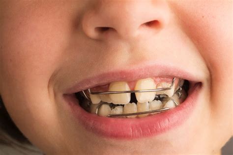 Uitneembare Beugels Orthodontiepraktijk Almere Stad