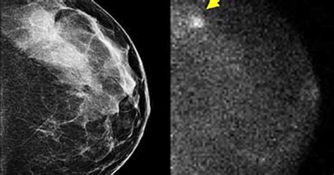 New Breast Cancer Detection Shows Promise Cbs News