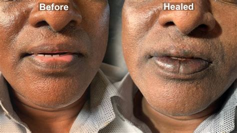 100 Organic Permanent Lip Vitiligo White Patch Treatment By Machu