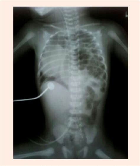 Figure 1 From Congenital Diaphragmatic Hernia With Right Pneumothorax