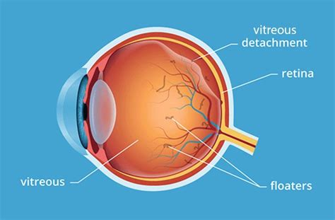 Posterior Vitreous Detachment All About Vision