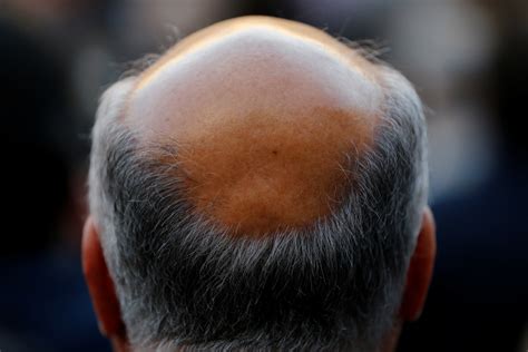 South Korean Scientist Claims To Have Found Cure For Baldness