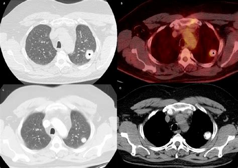 Figure 1 From Pulmonary Hyalinizing Granuloma A Rare Cause Of A Benign