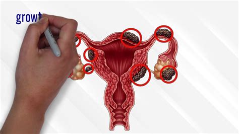 Endometriosis Everything You Need To Know About Endometriosis YouTube