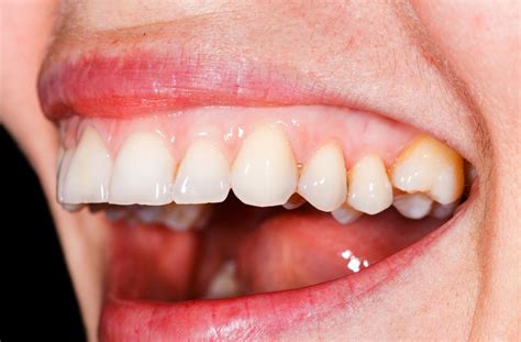 Green Stains On Teeth Near Gums Petmd