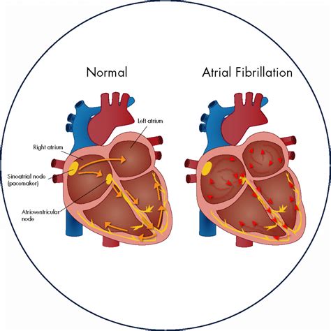 What Is Atrial Fibrillation Afib Institute