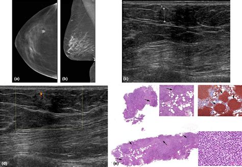 Malignant Hyperechoic Breast Lesions At Ultrasound A Pictorial Essay