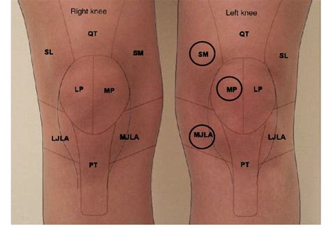 Post Cryotherapy Photographic Knee Pain Map Pkpm Highlighting Areas