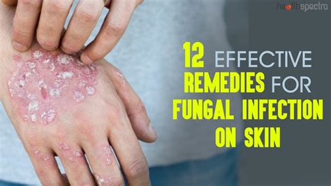 12 Effective Remedies For Fungal Infection On Skin Healthspectra