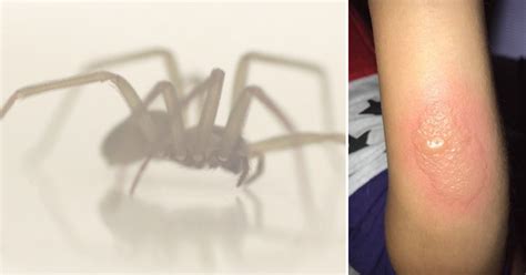 5 Pictures What Does Brown Recluse Spider Bite Look L