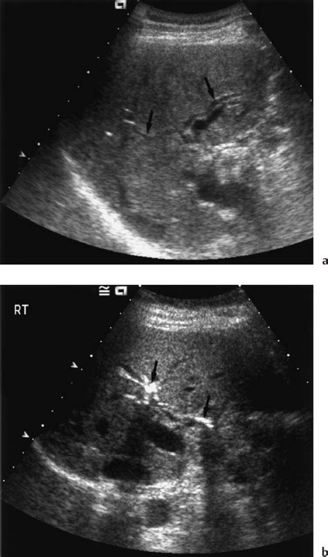Ultrasound Follow Up Of Liver Transplantation Radiology Key