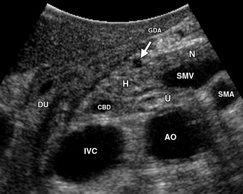 Pancreatic Anatomy Ultrasound My Xxx Hot Girl