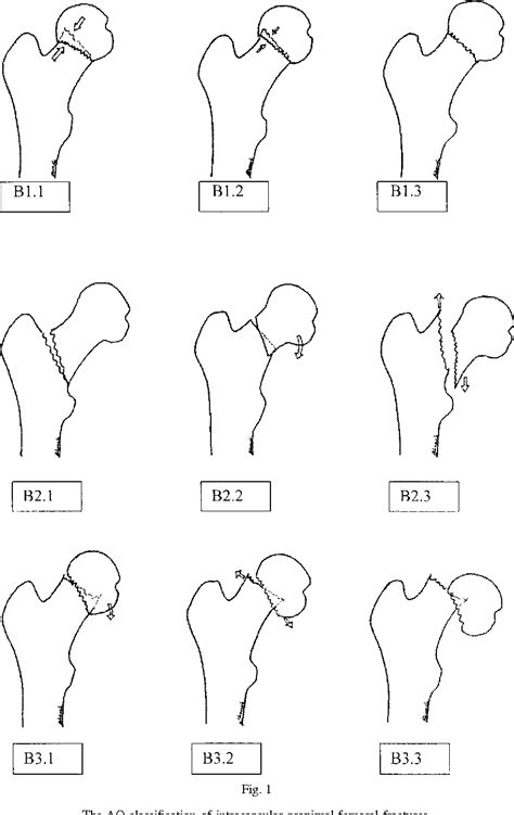 Ao Proximal Femur Classification 221840 Ao Proximal Femur Fracture