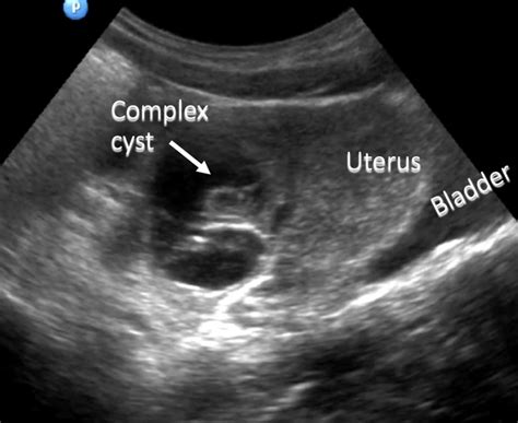 pelvic ultrasound ovarian cyst and summing up