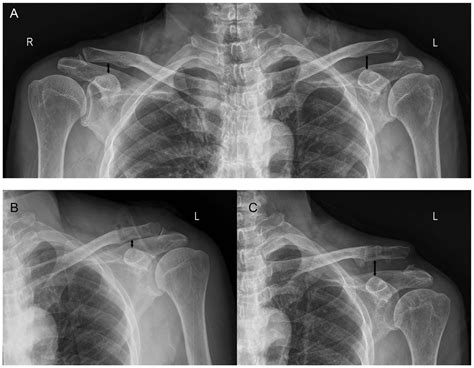 A Prospective Study Of Coracoclavicular Ligament Reconstruction With