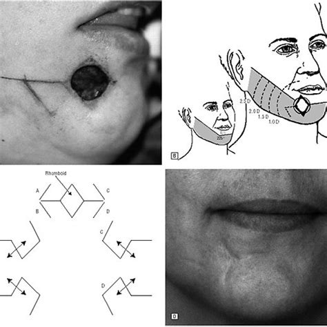 Eight Flap Types To Use During Facial Defect Reconstruction The Shaded