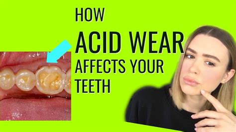 Protect Your Teeth From Acid Wear Youtube