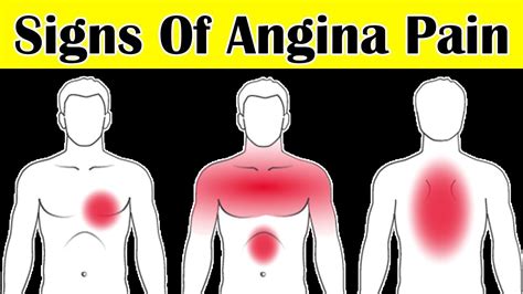 How Do I Know If I Have Angina Pain Early Signs Of Angina Pectoris