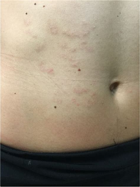 Cutaneous Larva Migrans Presenting With Folliculitis In The American