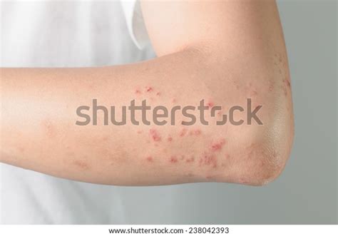 Atopic Dermatitis Allergic Chemicalsitchy Skin Lesions Stock Photo