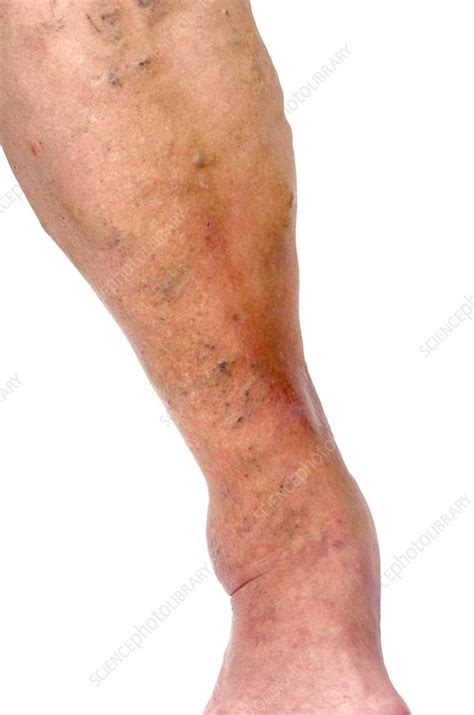 Lipodermatosclerosis Of The Leg Stock Image C0139722 Science