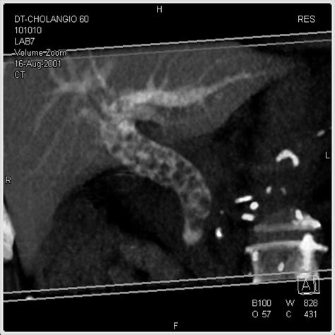 Fragmenting and removing a complex biliary stone under direct visualization. A vast number of biliary stones visualized in the ...