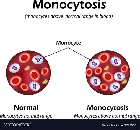 Monocytes Above The Normal Range In The Blood Vector Image