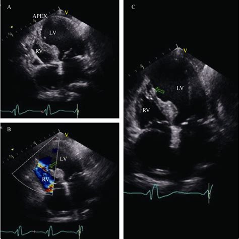 Echocardiography A Left Apical Aneurysm The Left Ventricle Was