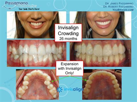 Invisalign Female Widen Pretty Smile Passamano Orthodontics