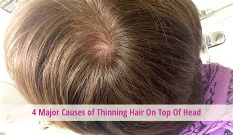 With a matter product, you can add texture to this look giving it a thicker and more dynamic look. Major Causes of Thinning Hair On Top Of Head