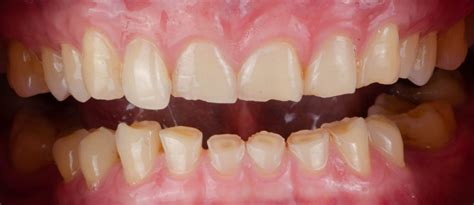 Understanding Bruxism And Tooth Wear