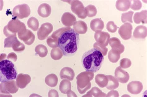 Band Neutrophils Hematology Atlass Pinterest Hematology