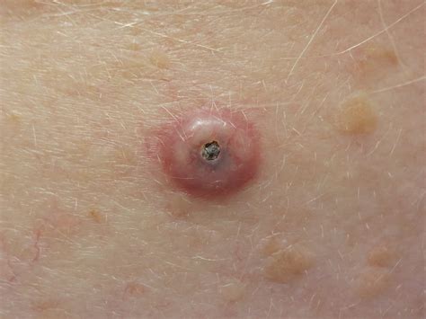 What Is Cutaneous Squamous Cell Carcinoma Symptoms Causes Diagnosis Images And Photos Finder