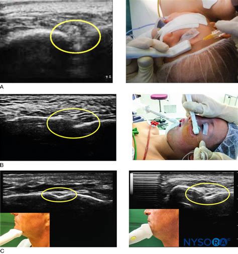 Regional Anesthesia Ultrasound Imaging For Superficial Trigeminal Nerve