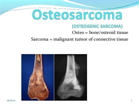 Osteosarcoma Symptoms Causes And Homeopathic Treatment